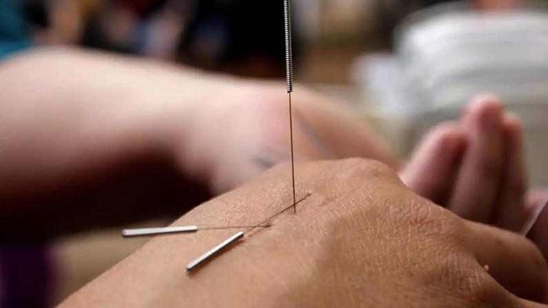 Acupuntura