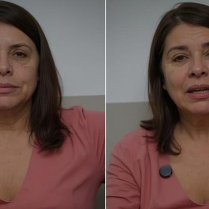 Mara Maravilha faz lifting facial e mostra resultado