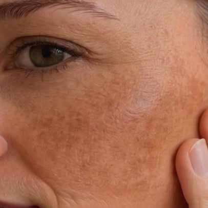 Melasma na gravidez: o que é, como prevenir e quando tratar