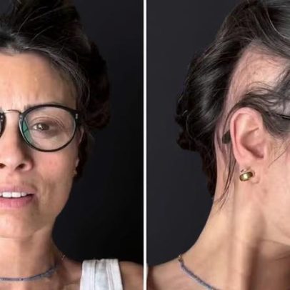 Apresentadora revela queda de cabelo severa e que está dois terços careca