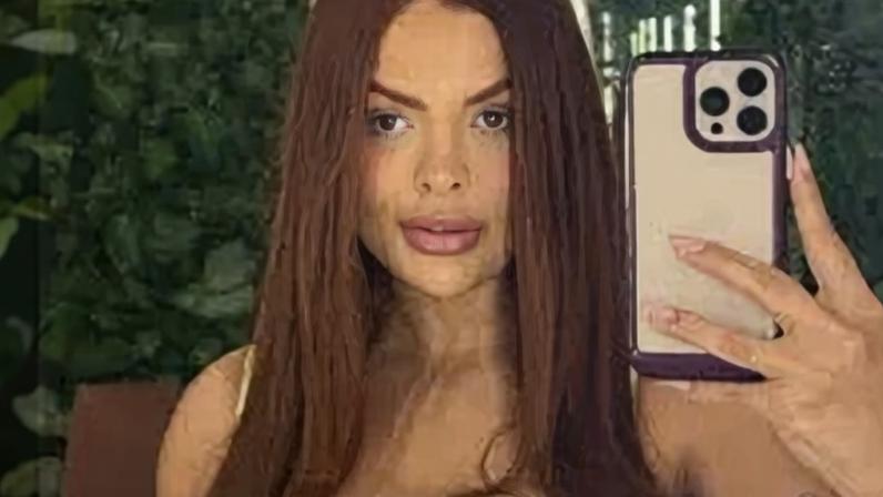 Paula Freitas passa por lipo de face e encontra grumos no pescoço