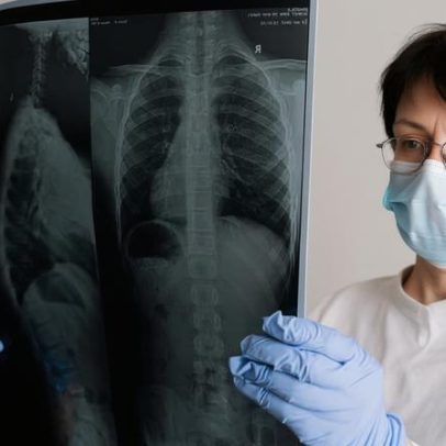 Estudo mostra controle de câncer de pulmão avançado por mais de sete anos