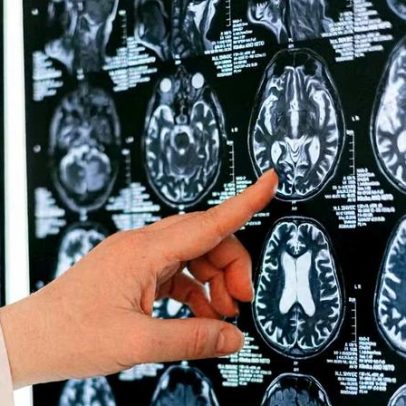 Como o cérebro faz detox? Estudo aponta mecanismo