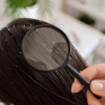 Frio e ar seco aumentam caspa, aponta dermatologista