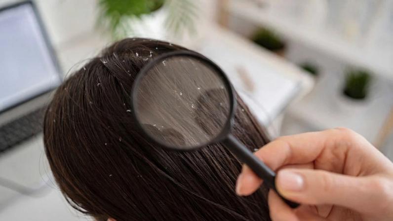 Frio e ar seco favorecem o aparecimento de caspa, diz dermatologista