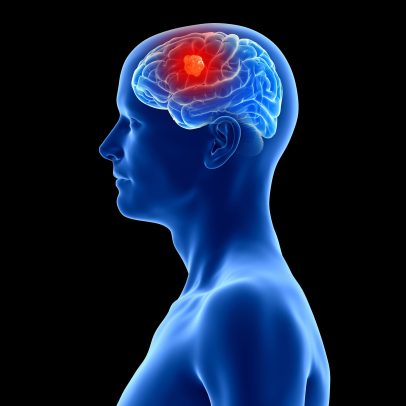 Três pessoas recebem implantes cerebrais que detectam câncer