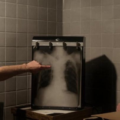 IA e novas estratégias aceleram o combate à tuberculose