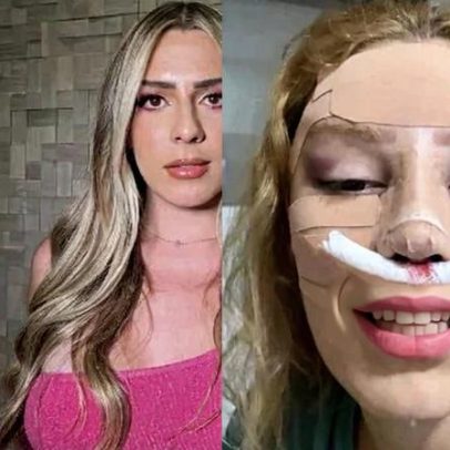 Primeiras fotos de Malévola após cirurgia de R$ 80 mil