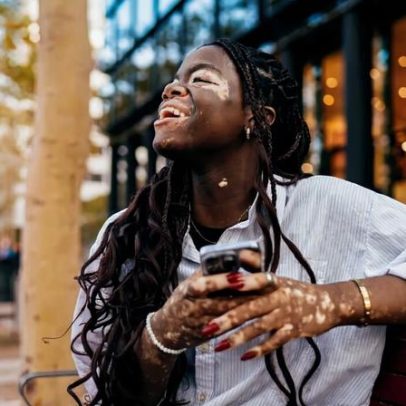 Tratamentos para vitiligo devolvem cor da pele em muitos pacientes