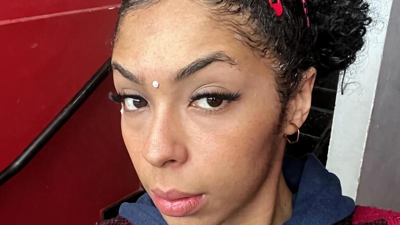Mulher em tratamento por alopecia de tração- Metrópoles