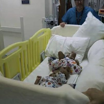 Siamesas unidas pela cabeça passam por cirurgia de separação; veja como estão agora