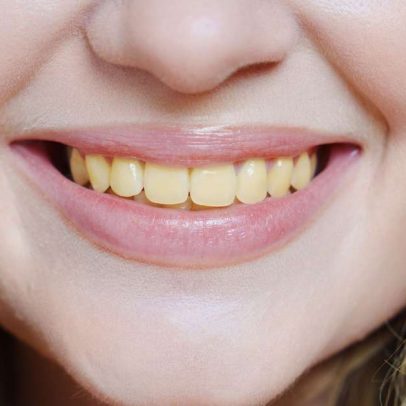 Hábitos que escurecem o sorriso e como evitar dentes amarelados