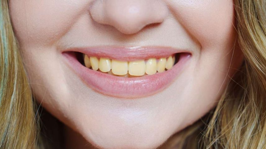 Dentes amarelados podem surgir por hábitos do dia a dia e até pelo envelhecimento; especialista explica como prevenir o problema