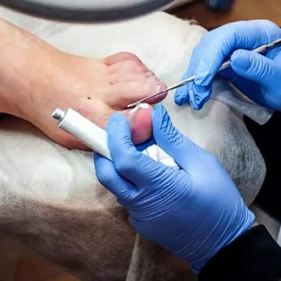 Cuidados com unha encravada ajudam a evitar complicações