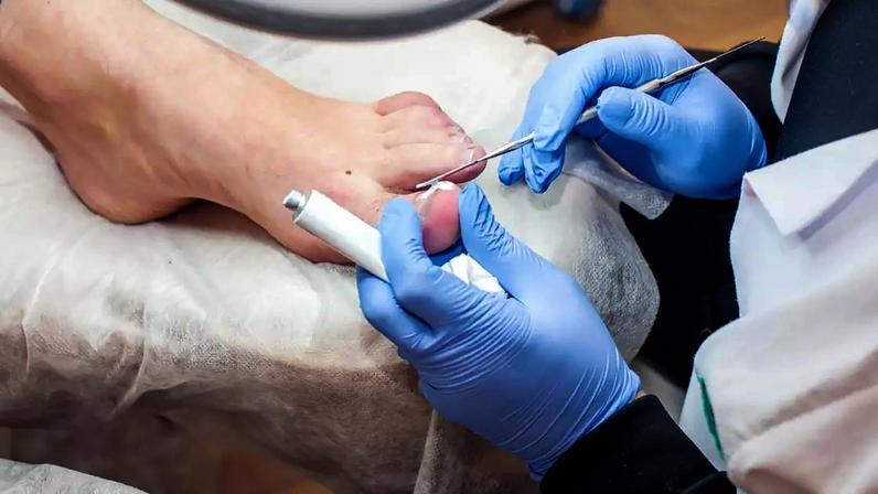 Mexer na unha encravada sem os cuidados adequados pode agravar o problema