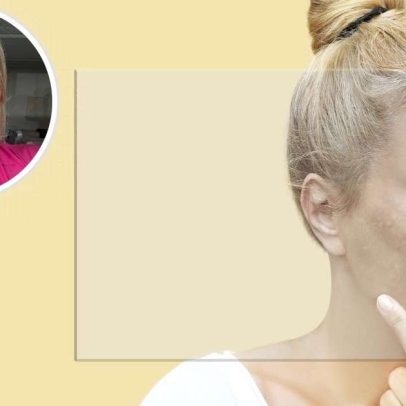Alimentação pode influenciar melasma, além dos cremes
