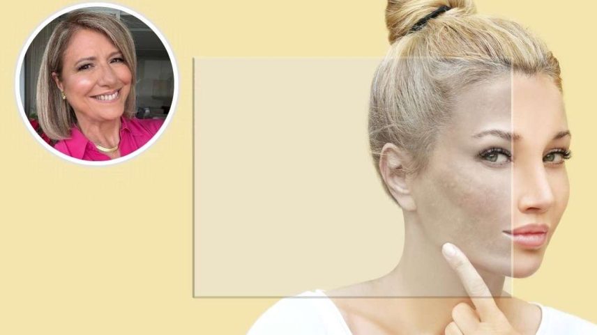 Nem só de cremes vive o tratamento do melasma: o que a alimentação pode mudar na pele
