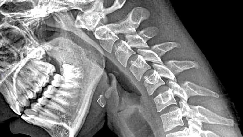 Postura da cabeça para frente coloca até 27 kg de pressão sobre o pescoço