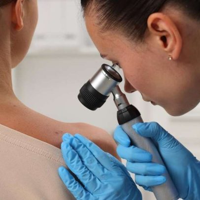 Sinais de alerta em pintas: como prevenir o melanoma