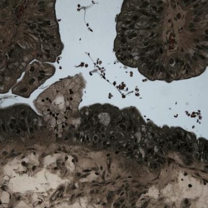 Composto à base de cobre é candidato a tratamento contra câncer de ovário