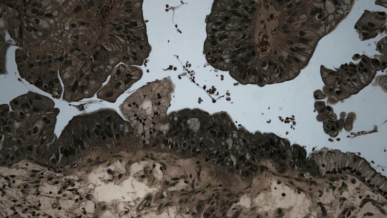Micrografia em ampliação de um tumor ovariano de baixo potencial maligno em cor de rosa no fundo branco