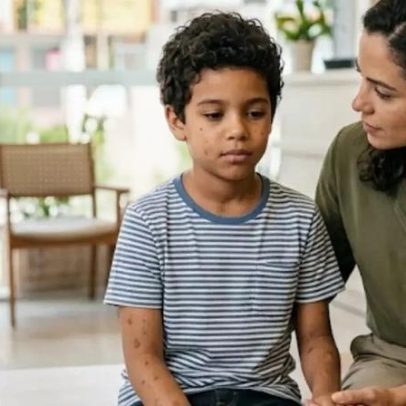 Neurofibromatose tipo 1: muitos só descobrem a doença tarde