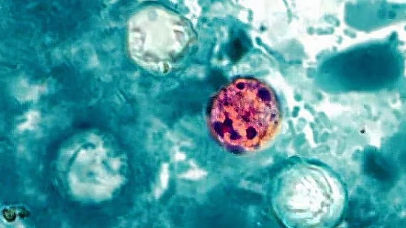 A ciclosporíase é uma infecção intestinal causada pelo parasita Cyclospora cayetanensis