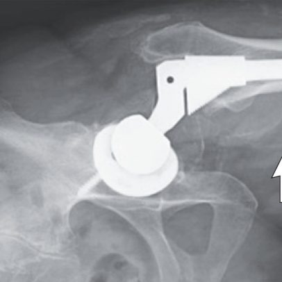 Caso raro: infecção por metal após deslocamento de prótese de quadril
