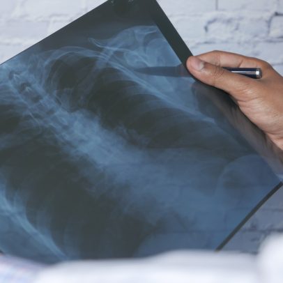 Anvisa aprova remédio para tratar câncer de pulmão avançado