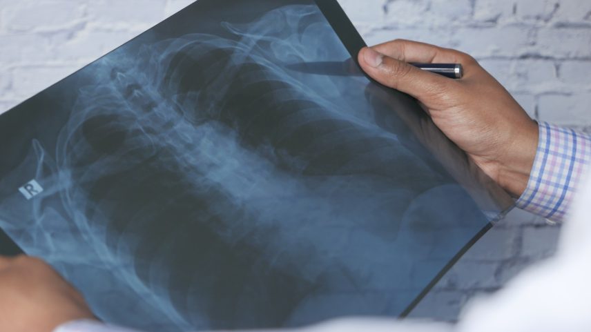 Anvisa aprova remédio para tratar câncer de pulmão avançado