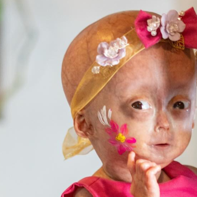 Elis, gêmea com síndrome de envelhecimento precoce, morre aos 5 anos