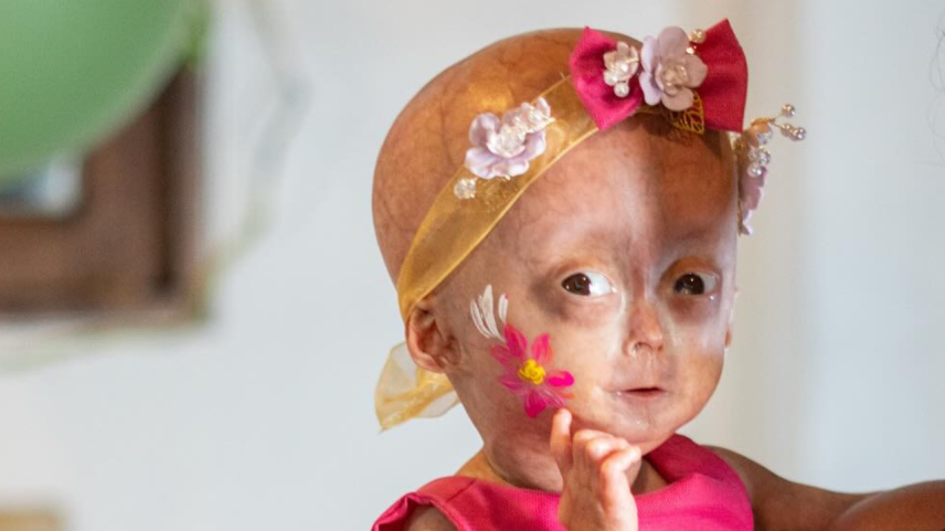 Elis, gêmea com síndrome de envelhecimento precoce, morre aos 5 anos