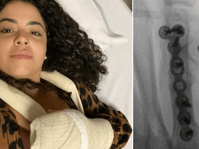 Erica se preparando para a cirurgia e, à direita, os dispositivos inseridos pelos médicos (Foto: Reprodução/Instagram/@ericaa_ssis)
