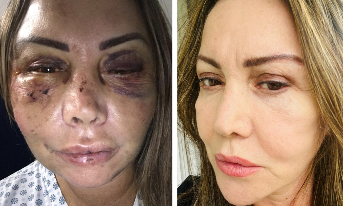 Mulher espancada no Rio se choca ao saber de agressão brutal em Natal Elaine Caparroz quando foi agredida e atualmente: sequelas e tratamento (Foto: Reprodução)