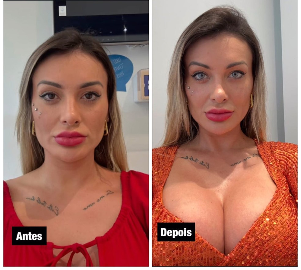 Urach revela temor de cegueira após mudança na cor dos olhos e alerta sobre riscos Andressa Urach relata dor e medo após mudança de cor dos olhos. (Foto: Reprodução)