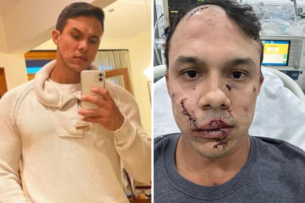Personal agredido relata dificuldades financeiras e cicatrizes no rosto O personal Thiago Medeiros Ribeiro Mendes, em foto de 2022, e depois de levar 45 pontos no rosto após agressões com um copo de vidro em bar de Águas de Lindóia (SP) (Foto: Arquivo pessoal)