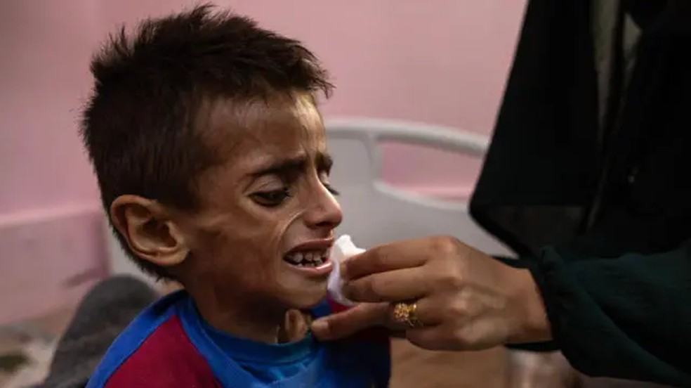 Criança desnutrida é tratada em Gaza (Foto: HAITHAM IMAD/EPA-EFE/Shutterstock)