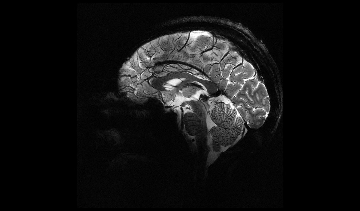 Mulher morre após aneurisma cerebral durante relação sexual; entenda o caso raro Imagem do Iseult Magneton 11.7 T MRI mostra cérebro humano. (Foto: Divulgação / Comissão de Energia Atômica da França (CEA))