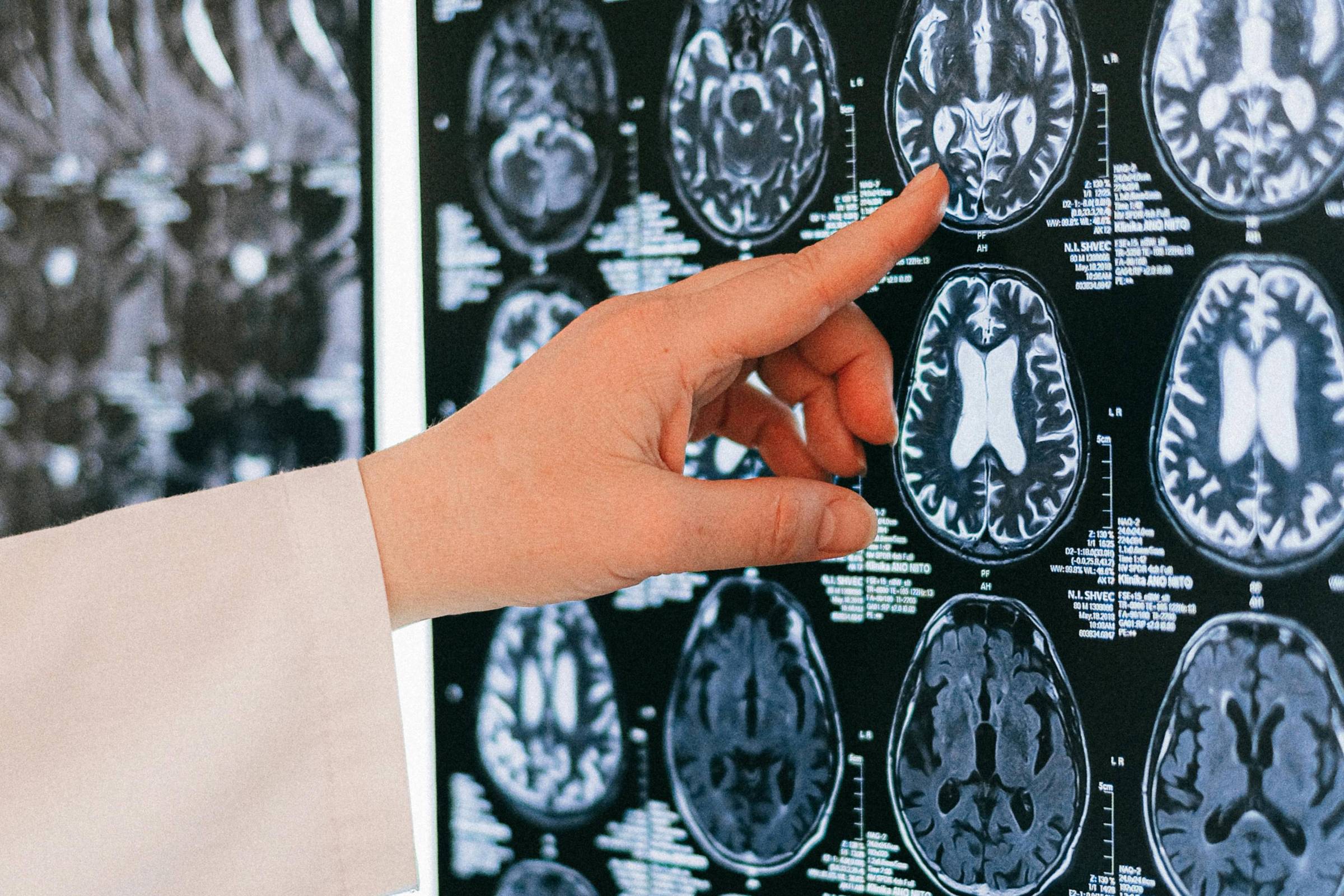 A associação entre diferenças em estruturas cerebrais e psicopatia é real, mas não é necessariamente determinista para o desenvolvimento do transtorno (Foto: Anna Shvets/Pexels)