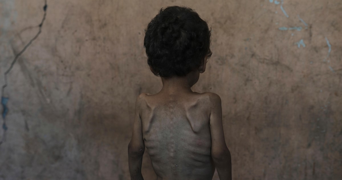 Israel enfrenta acusações de genocídio em Gaza e gera debate internacional Yazan Abu Ful, de 2 anos, desnutrido, posa para uma foto na casa de sua família no campo de refugiados de Shati, na Cidade de Gaza, na quarta-feira, 23 de julho de 2025 (Foto: Jehad Alshrafi/AP)