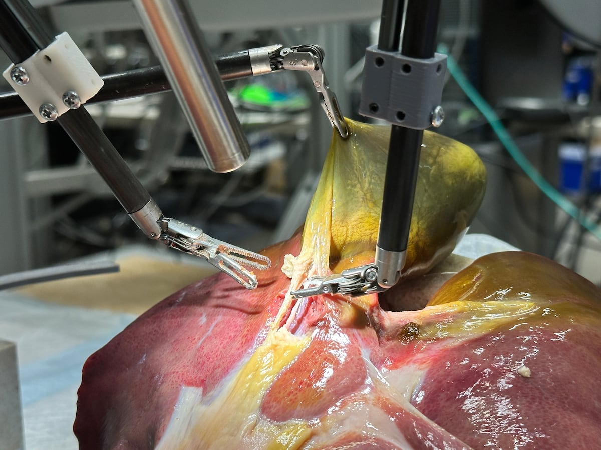 Máquina cirúrgica demonstra potencial para substituir cirurgiões humanos no futuro O novo sistema, que combina inteligência artificial generativa e aprendizado de máquina, apresentou 100% de precisão em algumas das tarefas cirúrgicas necessárias para remover vesículas biliares de porcos. (Foto: Juo-Tung Chen/Johns Hopkins University)