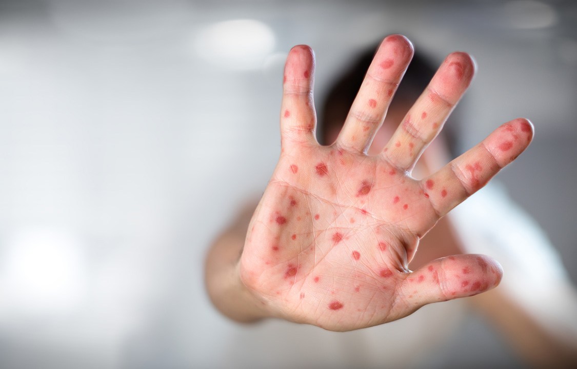 Casos de sarampo nos EUA alcançam maior nível em 25 anos de erradicação Sarampo é uma das infecções mais contagiosas que afetam os seres humanos (Foto: iStock/iStock)