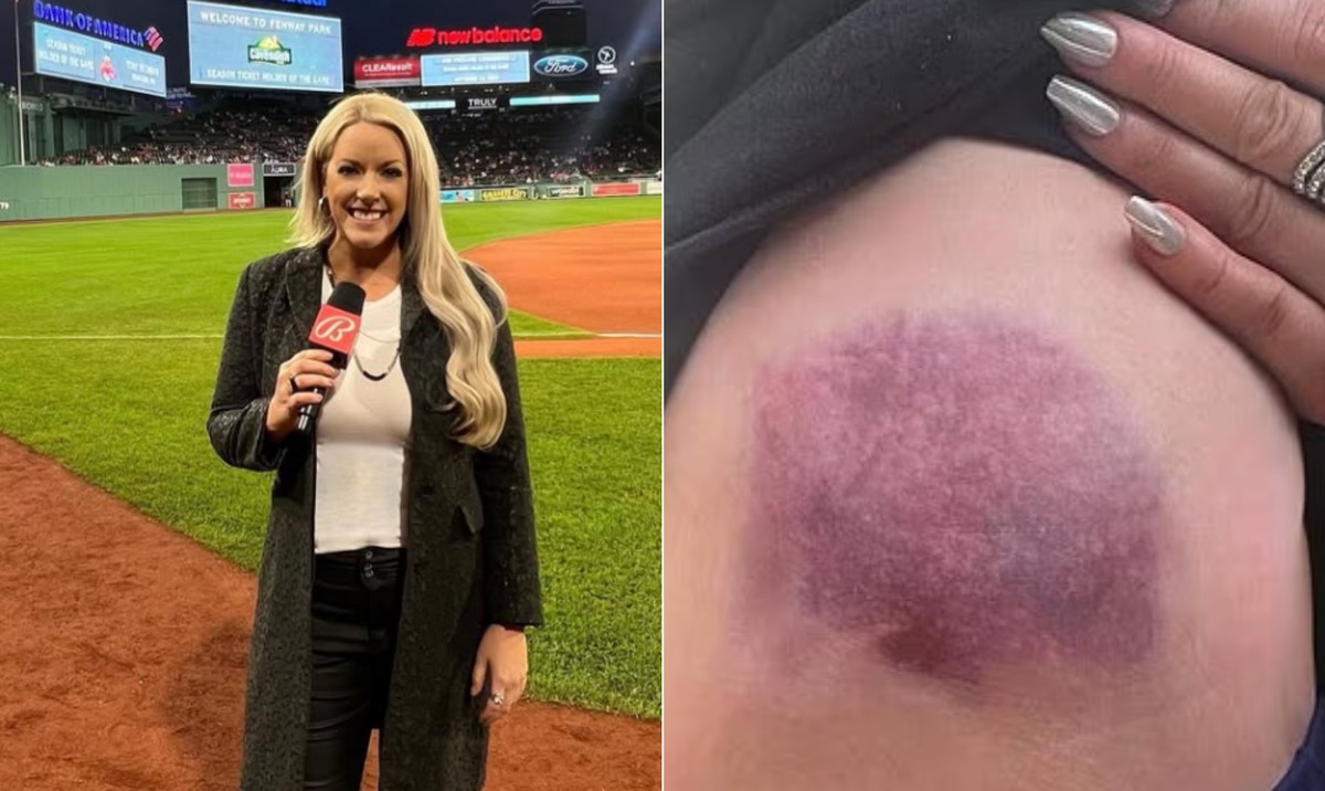 Bola de beisebol atinge repórter e causa hematoma durante partida emocionante Repórter Audra Martin (Foto: Reprodução/Instagram)