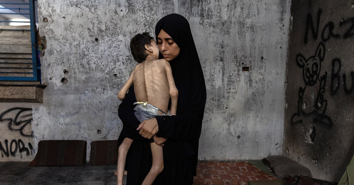 Enfermeiros em Gaza enfrentam a fome em meio à crise humanitária crescente Samah Matar segura seu filho Yousef, de 6 anos, ao norte da Cidade de Gaza, na quinta-feira, 24 de julho de 2025. Yousef tem paralisia cerebral e desnutrição grave. Ele pesava cerca de 13 quilos antes da guerra, mas agora pesa cerca de 9 quilos. (Foto: Saher Alghorra/NYT)