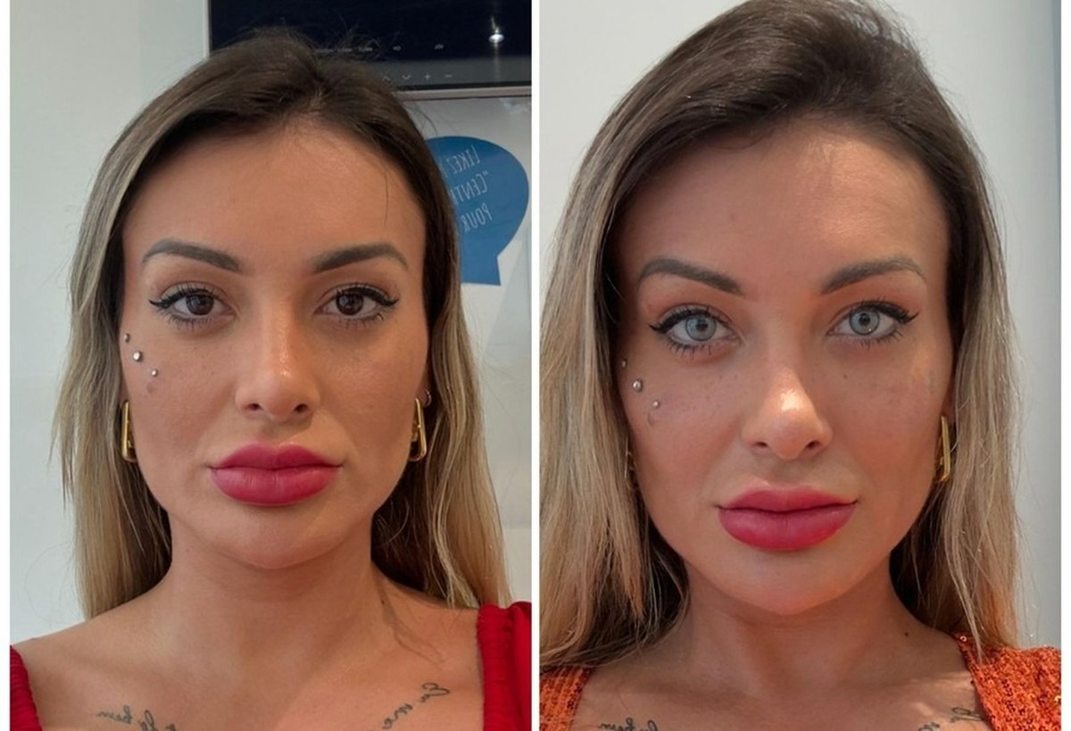 Andressa Urach realiza cirurgia de queratopigmentação para mudar a cor dos olhos Andressa Urach antes e após mudança da cor dos olhos (Foto: Reprodução/Redes Sociais)