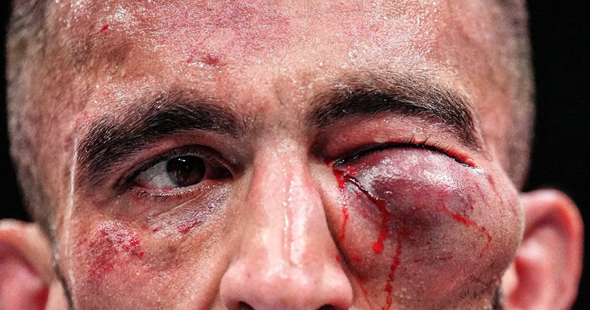 Lutador sofre inchaço no olho após luta intensa e chama atenção no UFC