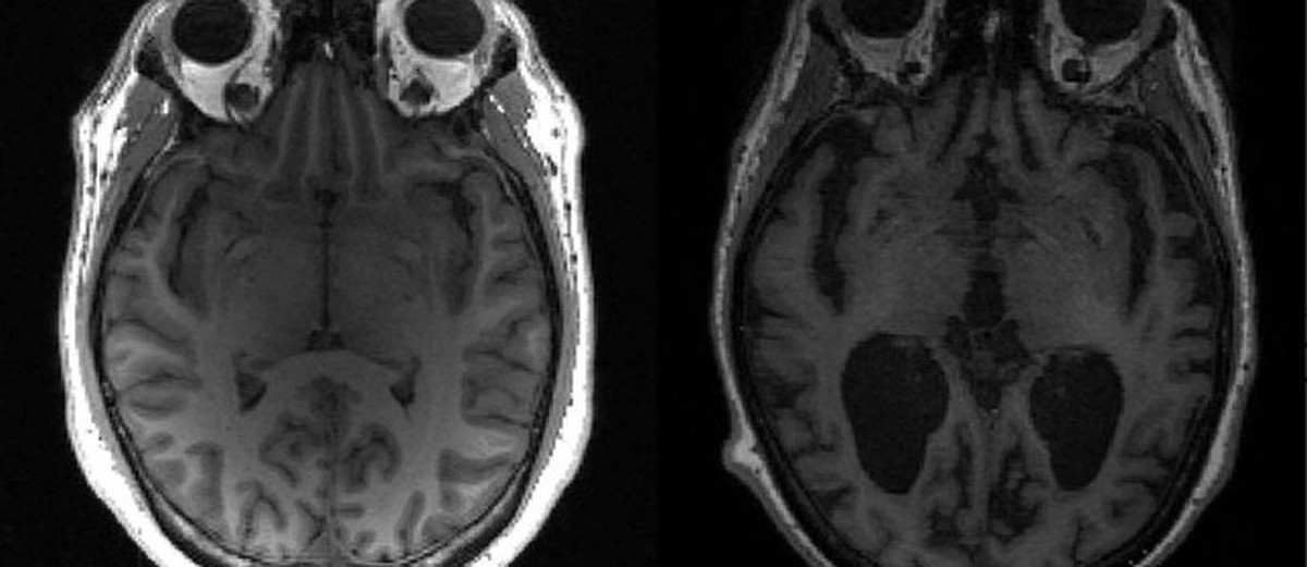 Cérebro saudável à esquerda e cérebro com Alzheimer à direita. (Foto: Reprodução)