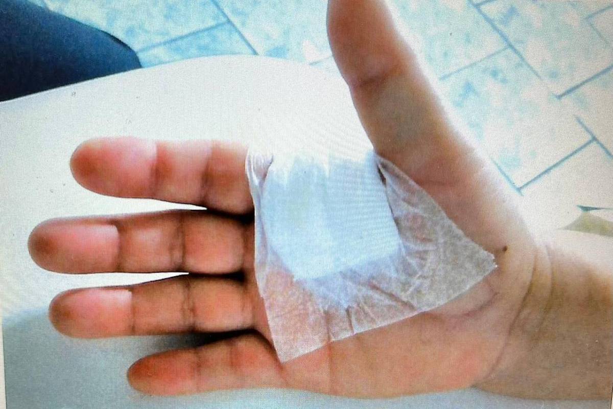 Curativo em paciente que acusa médico de ter operado dedo errado (Foto: Arquivo Pessoal)