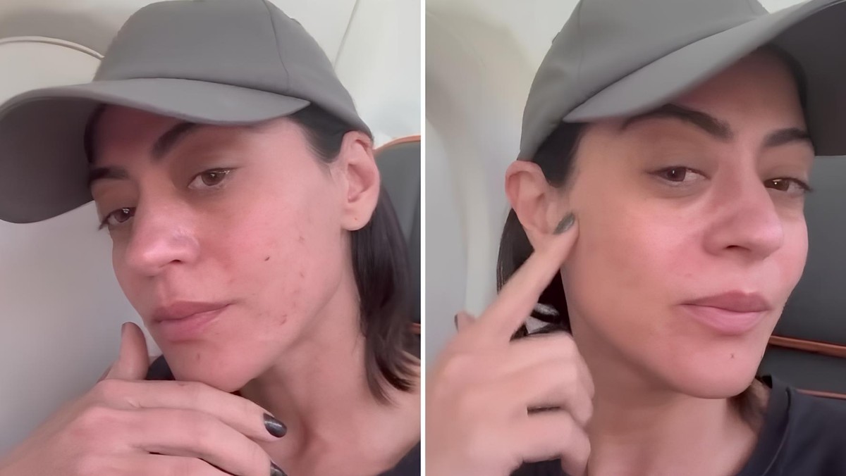 Rosácea afeta a saúde da atriz Carol Castro e gera preocupação entre fãs Carol Castro mostra pele com rosácea (Foto: Reprodução/Redes Sociais)