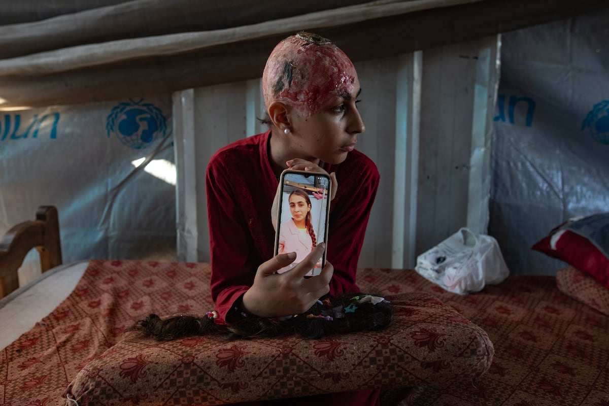 Israel planeja transferir 600 mil palestinos para Rafah em novo plano de realocação Hala Abu Dahlez, uma menina palestina de 12 anos, mostra uma foto sua tirada antes da lesão que sofreu quando um columpio metálico desabou sobre ela após um ataque aéreo israelense, em Al-Mawasi, Jan Yunis, no sul da faixa de Gaza, ontem. (Foto: HAITHAM IMAD/EFE)